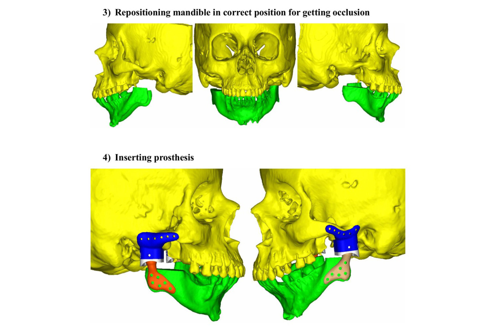 Primera cirugía maxilofacial de alta complejidad – UTE